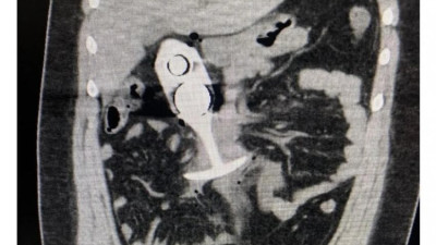 흔치않은 레일건 사고